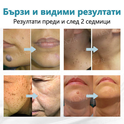 🌟Bikenda® Неинвазивна лазерна писалка за премахване на бенки и брадавици