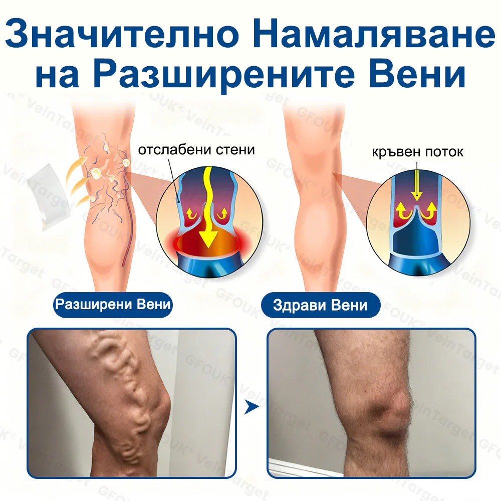 🎁GFOUK® Целенасочен микроиглен пластир за вени⚡Незабавно облекчение · Дълготрайни резултати